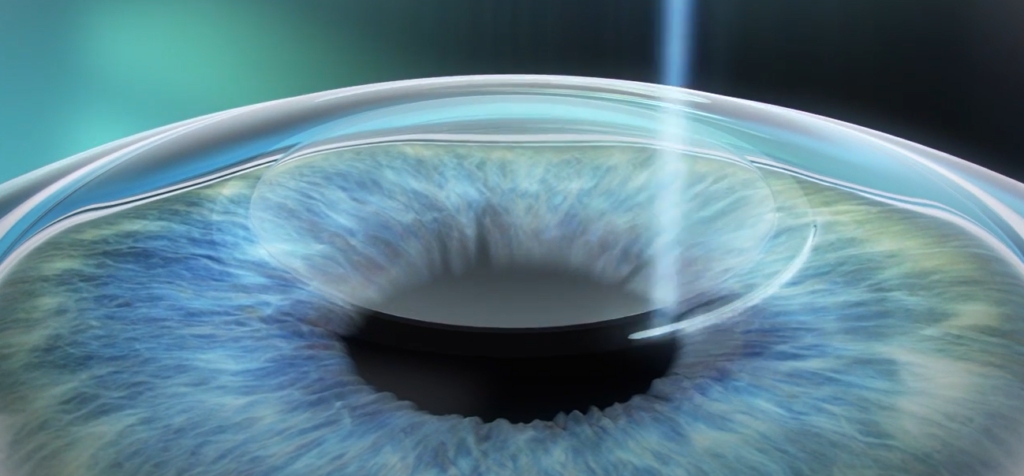 laser eye surgery process