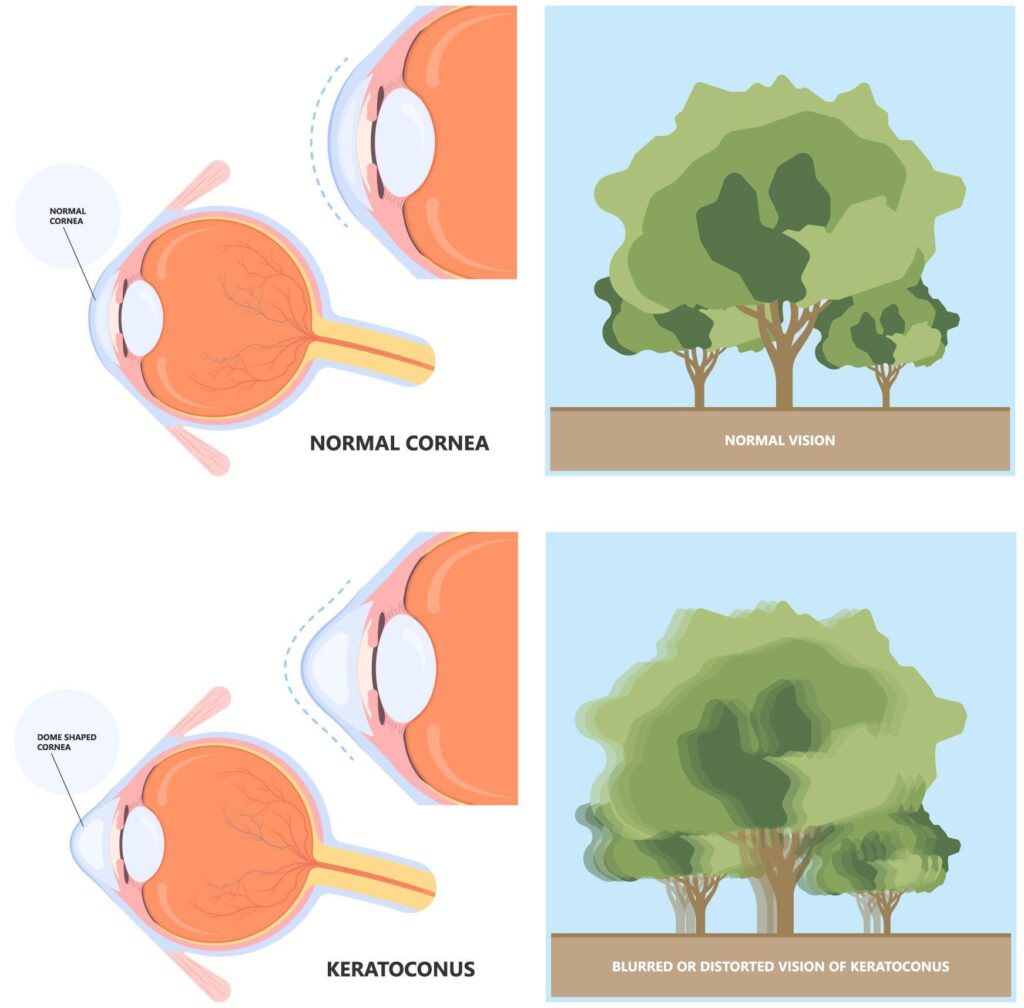 Keratoconus Explained Visually