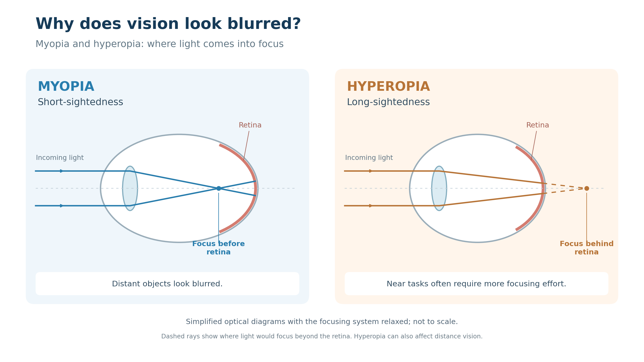 Diagram comparing myopia, where light focuses in front of the retina, with hyperopia, where light would focus behind the retina when the eye is relaxed.
